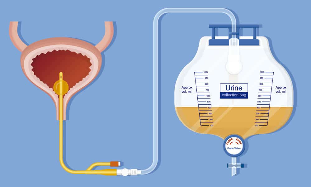 images/noticias/1551707370-Preevidrespondecualeseltiempodemantenimientodelsondajevesicaltrascirugiagastrointestinal.jpg