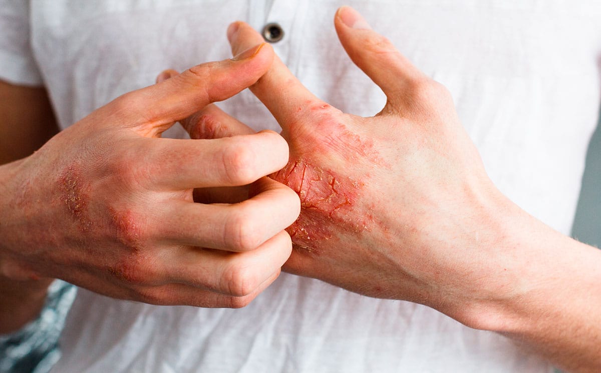 images/noticias/1623844052-psoriasis.jpg