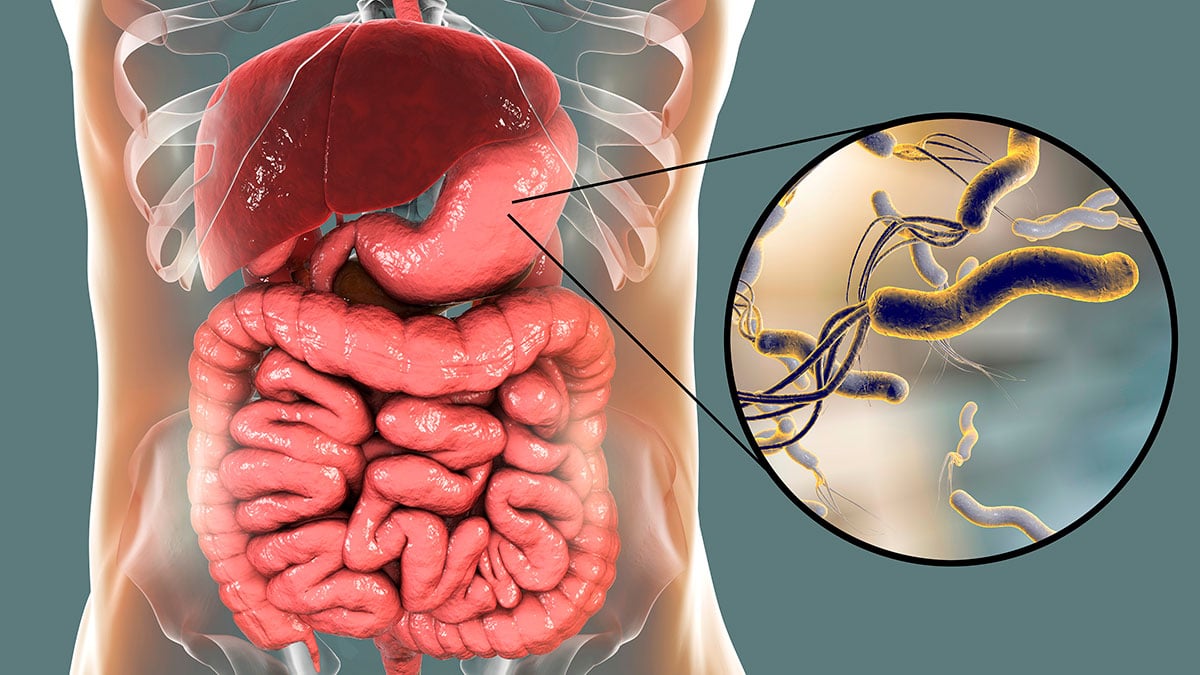 images/noticias/1623911736-LainfeccionporHelicobacterpylorieslaprincipalcausadeulceragastroduodenalyafectaal40delapoblacion.jpg