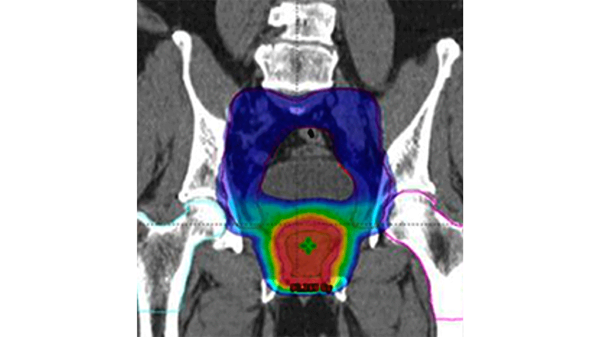 images/noticias/1623915205-Nuevastecnicasderadioterapiamejoranelcontrolylasupervivenciadelcancerdeprpstata.png