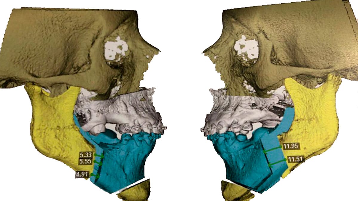 images/noticias/1626950479-QuironsaludCampodeGibraltarrealizaconexitounainnovadoracirugiaortognaticatrimaxilarquehapermitidolarecolocacionsimultaneadelamandibulamaxilarsuperiormentonynariz.jpg